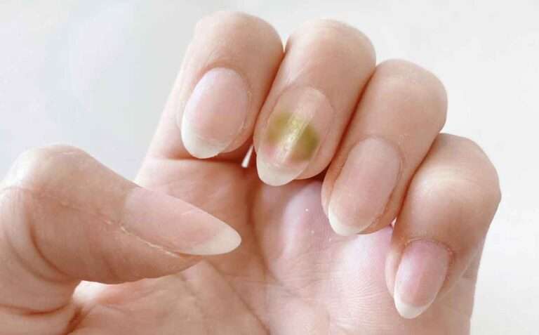 グリーンネイルは伝染るの？爪の病気|伏見区ネイルサロン